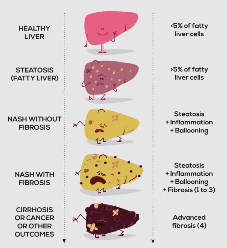 Non-alcoholic steatohepatitis (NASH) progression. 
➡️ NASH is typically caused by a buildup of fat in the liver, which triggers inflammation and eventually leads to liver damage. 
➡️ Factors contributing to NASH include obesity, insulin resistance, high blood sugar, high levels…