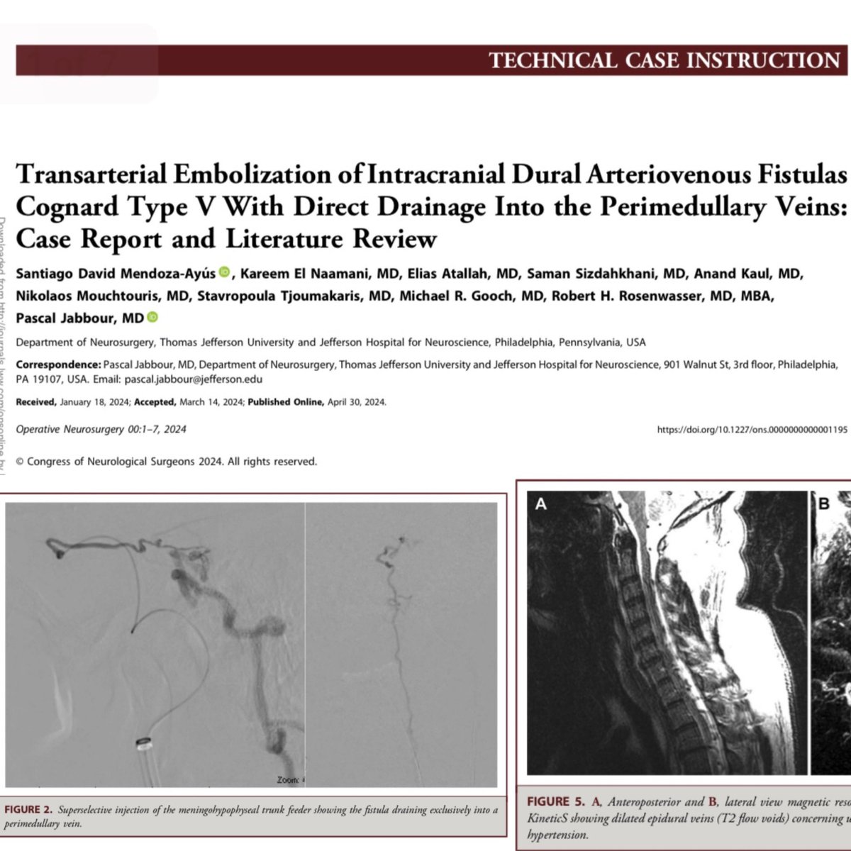 Cognard V DAVFs are rare lesions, clinical presentation can be tricky ! Hot off the press nicely executed by a superstar visiting med student @santimendozayus from Universidad Del Rosario Bogota Colombia @TJUHNeurosurg @JeffersonUniv @TJUHospital