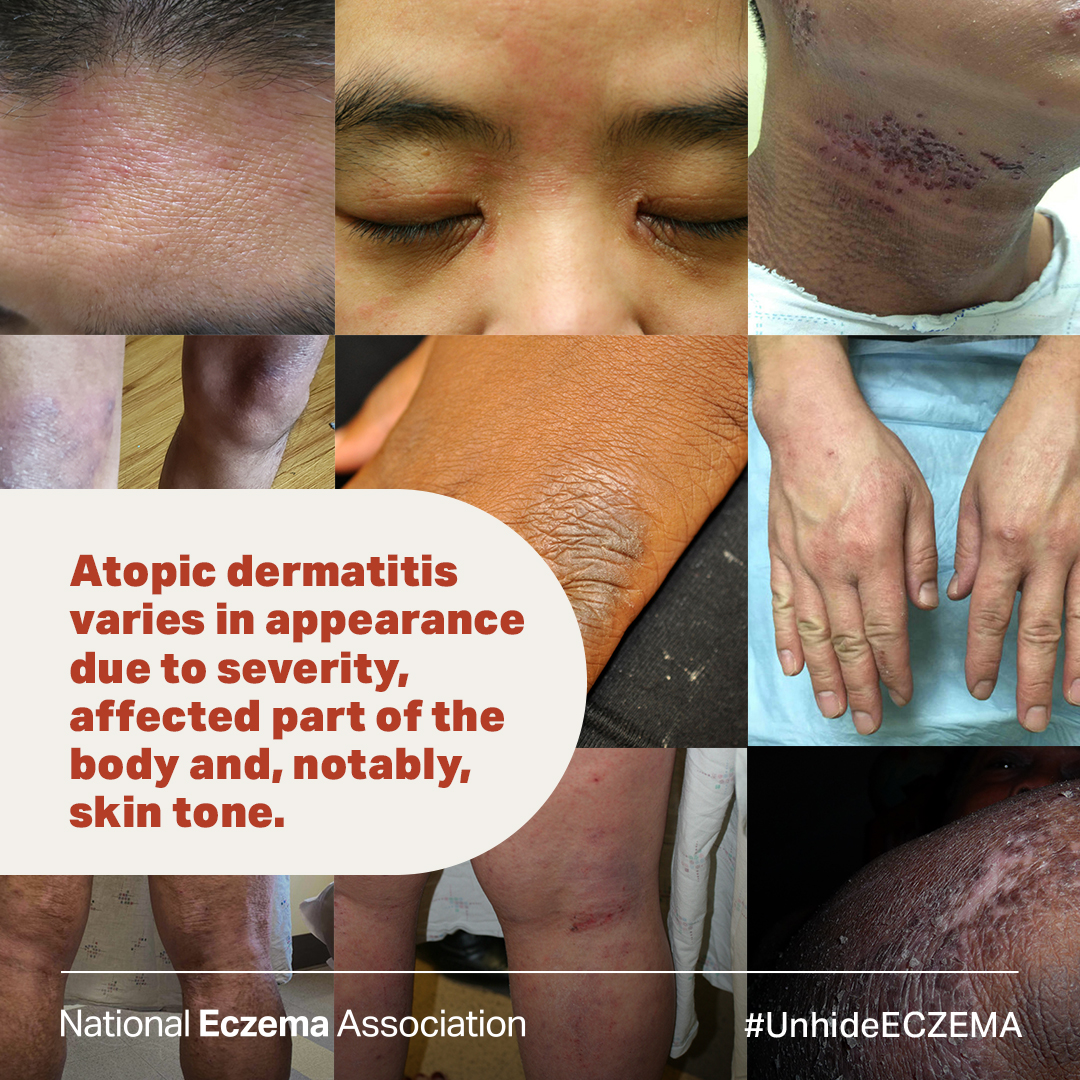 Eczema is unique to each individual. ✨ 
⁠
Browse the Atopic Dermatitis Visual Guide to view a broader spectrum of #eczema on various skin tones and body parts: nationaleczema.org/visual-guide/

#GetEczemaWise #atopicdermatitis #unhideECZEMA #skindisease #skincondition #skinhealth