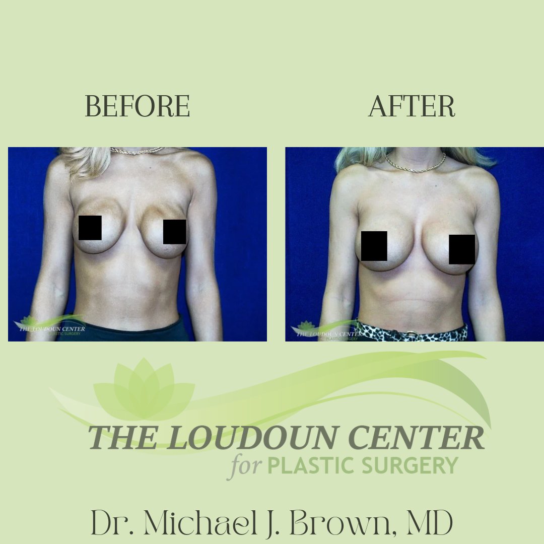 Out with the old, and in with the new! Check out this stunning breast implant exchange done by the one and only, Dr. Brown🤩 #PlasticSurgery #PlasticSurgeon #BreastImplants #ImplantExchange #BreastAugmentation #BreastSurgery #BeforeAndAfter