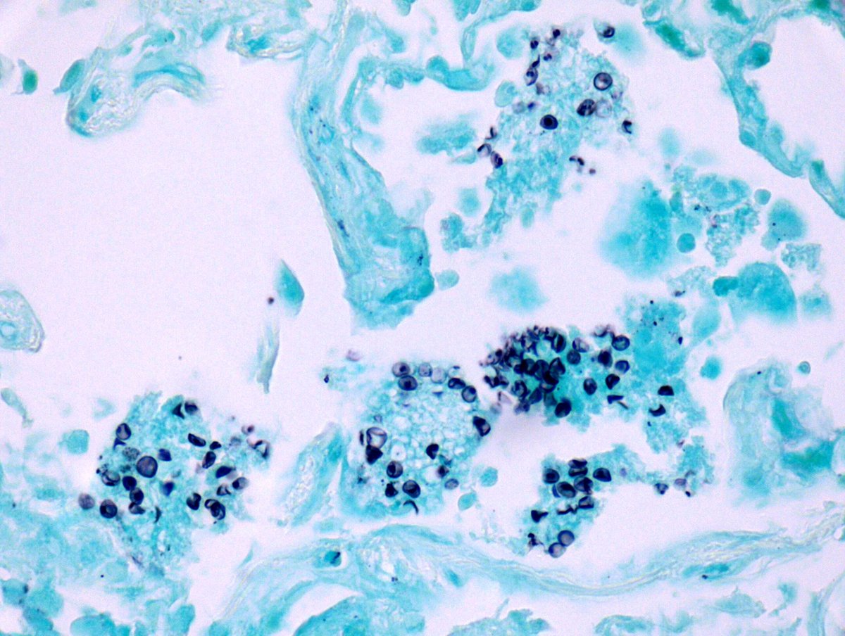 A 50 year old man with hypoxia and bilateral interstitial infiltrates on chest imaging showed intra-alveolar foamy material. Grocott-Gomori methenamine silver (GMS) stain is shown in the figure below. What's the diagnosis? (Continued)

#PathTwitter #ImageQuiz #PathologyOutlines
