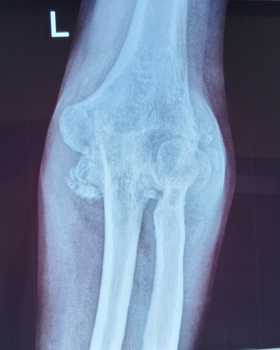 It is incomprehensible why someone will take 30 years after dislocating an elbow joint to finally seek Orthopaedic care! Elbow dislocations are treated as emergencies to prevent unnecessary disability!