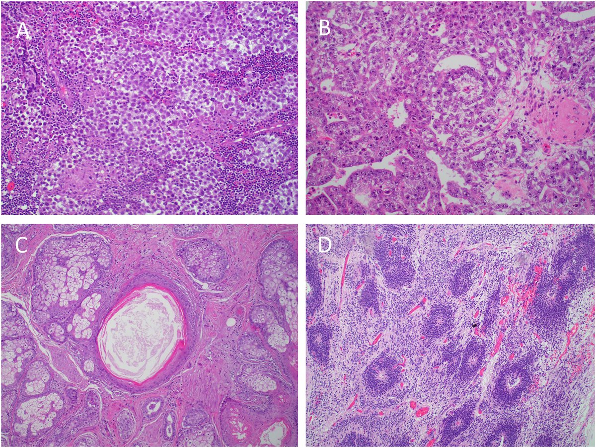 New in #HumPathol: Extragonadal Germ Cell Tumors: A Clinicopathologic Study with Emphasis on Molecular Features, Clinical Outcomes and Associated Secondary Malignancies. sciencedirect.com/science/articl… #pathology #PathTwitter #PathX #GUpath