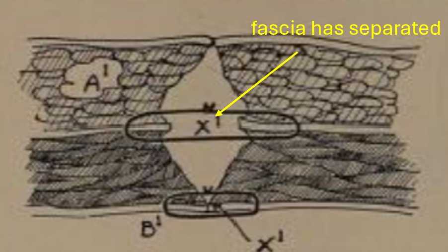 The explanation is simple:

Suture A has a longer length because it had to go through the extra tissue.  But it was just fat and muscle, and that will necrose after the sutures have actually been tied.

The fascial edges will then loosen, leaving a gap (and likely a hernia).