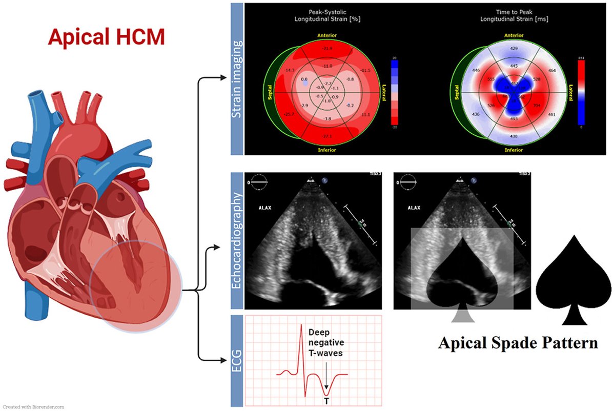 Apical hypertrophic cardiomyopathy (AHCM) is a rare phenotypic variant of #HCM. In this @CASEfromASE report, we introduce the “blueberry-on-top” phenomenon, a characteristic myocardial strain finding on TTE, to help identify AHCM cases. bit.ly/49DNa1Y