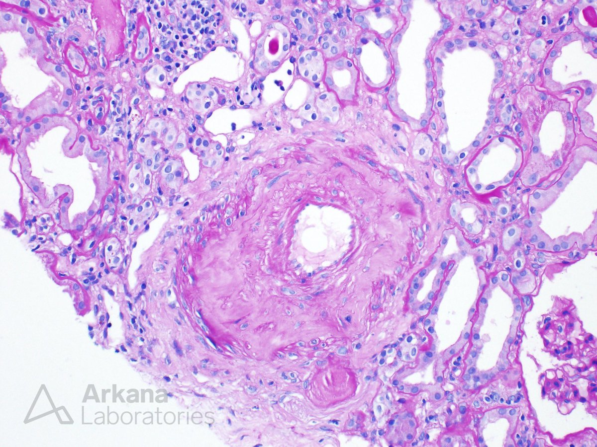 #TeachingPoints A very common vascular histologic finding in patients with hypertensive nephrosclerosis is arteriosclerosis. In advanced lesions, such as this example, there is prominent intimal fibrosis with narrowing of the vessel lumen. The replacement of smooth muscle cells