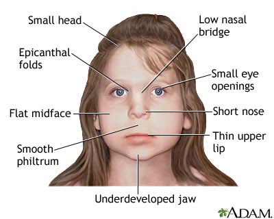 @bennyjohnson FASD- Fetal Alcohol Syndrome Disability.   Their mothers drank and possibly did drugs while pregnant.  

FASD causes lowered birth weight and impaired cognitive ability.  Very identifiable facial features.