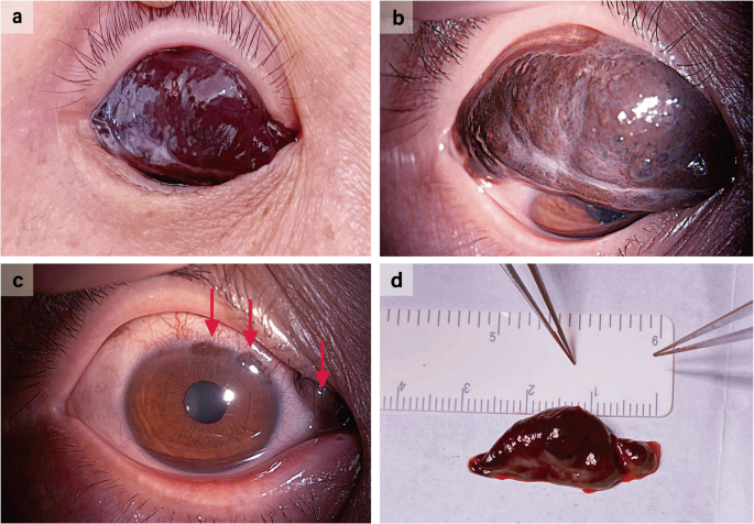 Ophthopedia Update: Giant conjunctival nevus dlvr.it/T6DMb7 #Ophthalmology #Eye #Ophthotwitter