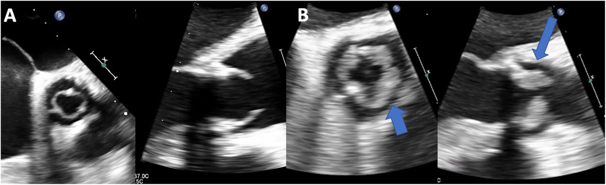 Valvulitis: a new echocardiographic criterion for the diagnosis of bioprosthetic aortic valve infective endocarditis #REC #AheadOfPrint @pablozf0 @epozoosinalde @danigarar @CarlosNicolsPr3 @manuel_carnero @patmahia @AdrianJeronimoB @FabianIslas21 revespcardiol.org//en-valvulitis…