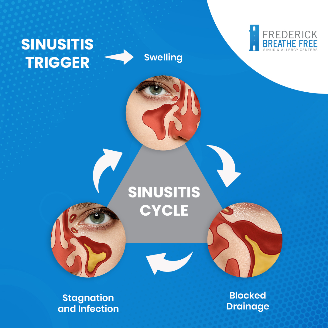 We are the CYCLE BREAKERS!

#Sinusitis
#CycleBreakers
#KnowTheSigns