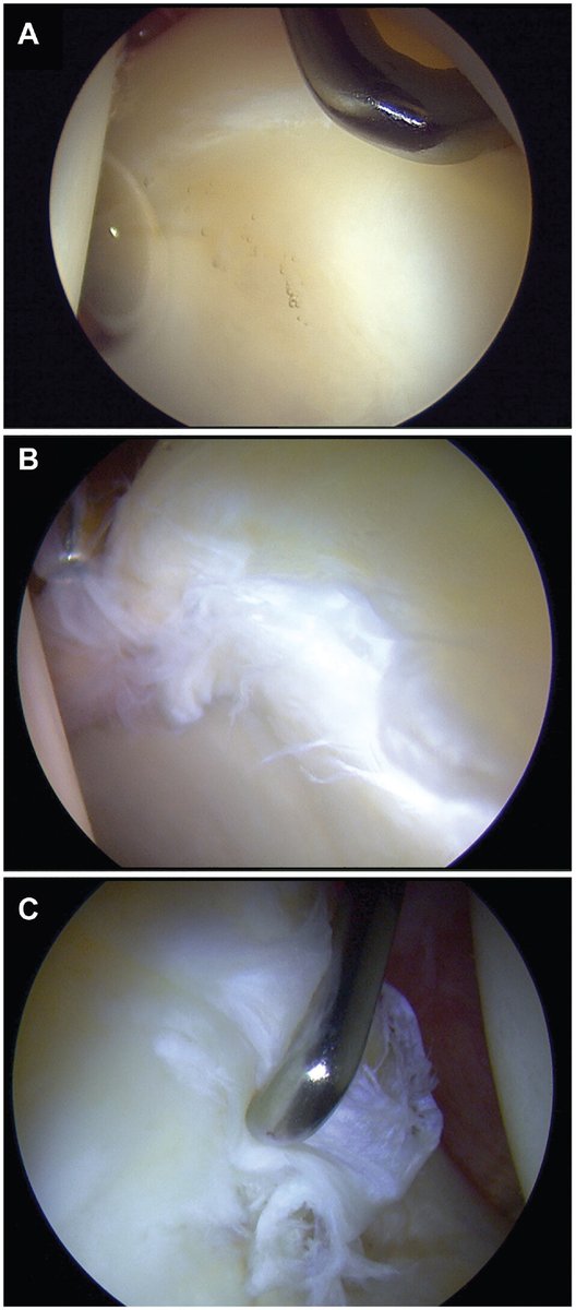 The cartilage grade at the chondrolabral junction is key to long-term hip arthroscopy survivorship – grade 3 &4 have <50% survivorship to THA at 10-years. #OpenAccess #orthotwitter @SDMartinMD ow.ly/fuNK50Row6q