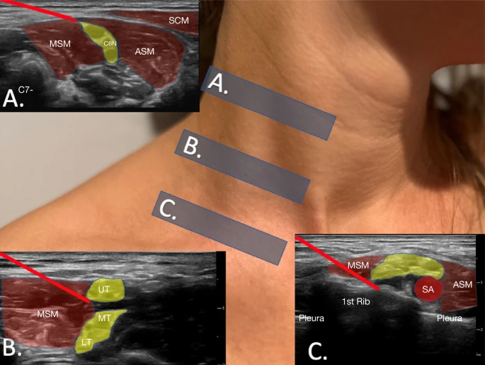 Just the facts: brachial plexus blocks for upper extremity injuries in the ED by @DanMirsch link.springer.com/article/10.100… What is a brachial plexus block, why would I do it, what are the complications and more in this JTF article! #POCUS