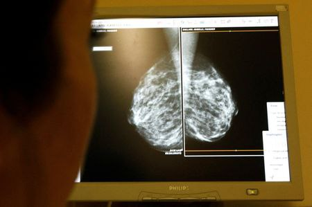 ⚠️  BREAST CANCER SCREENING SHOULD BEGIN AT AGE 40, U.S. PANEL SAYS

Full Story → PiQSuite.com/reuters/breast…

Women at average risk for breast cancer should get screening mammograms every other year starting at age 40, the U.S. Preventive Services Task Force (USPSTF) said on