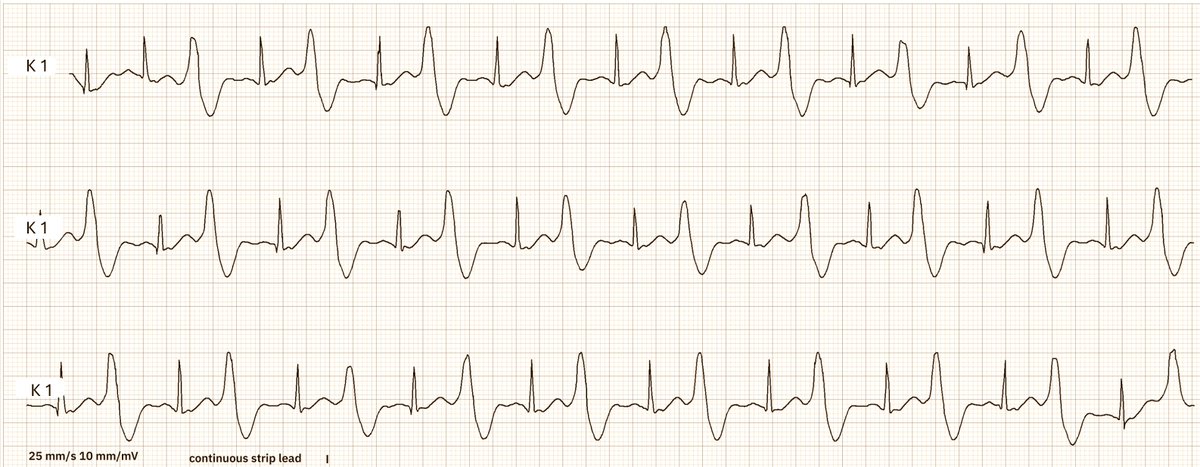 ecgandrhythmRoe tweet picture