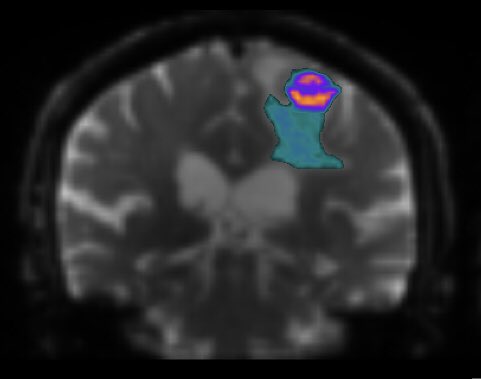 Ready to make a difference in cancer research? Join the @microCUBRIC group at @CUBRICcardiff! 
They are hiring for 1 PhD and 1 PostDoc position in brain tumor microenvironment mapping with ultra-strong gradient MRI. DM or meet me at #ISMRM24 next week for more details 😊