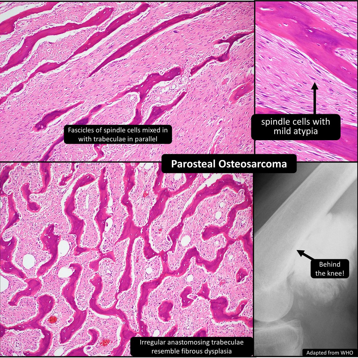 DrCycloPath's tweet photo. 🚫Adamatinoma: tibial diaphysis, lytic, spindle cells & epithelial islands
🚫Osteofibrous dysplasia: proximal tibia, lytic w surrounding sclerosis ± bowing, anastamosing trabeculae + spindle cells + osteoblastic rimming
🚫Osteochondroma: femoral metaphysis, mushroom cap & stalk, recapitulates growth plate
✅Parosteal Osteosarcoma: distal femoral periosteum, mineralized mass, irregular trabeculae ~fibrous dysplasia, woven bone + spindle cells