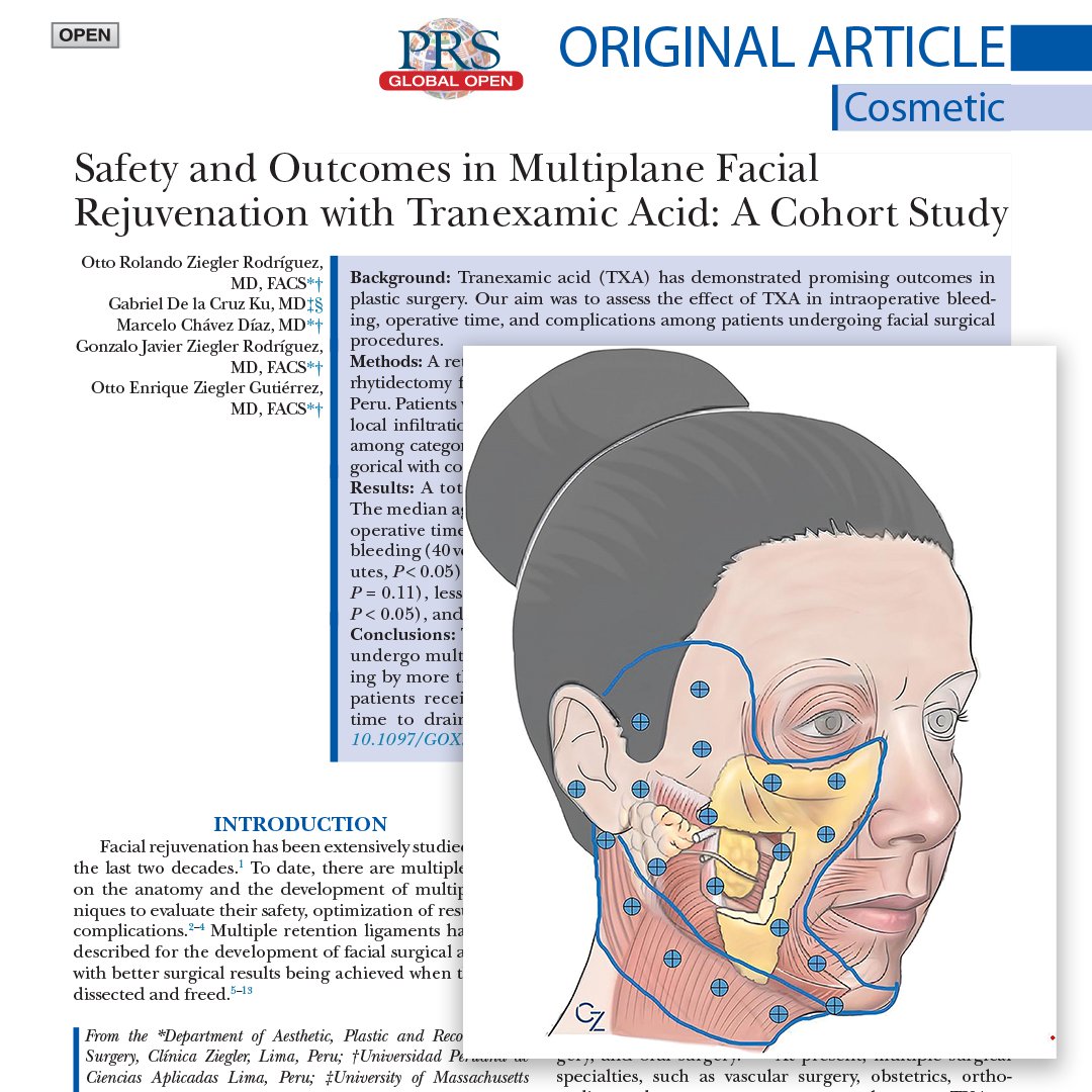 Does #tranexamicacid (#TXA) have an effect on the intraoperative bleeding, operative time, and complications among patients in facial surgical procedures? Read, 'Safety and Outcomes in Multiplane #FacialRejuvenation with Tranexamic Acid, ' to find out: bit.ly/FacialMultipla…