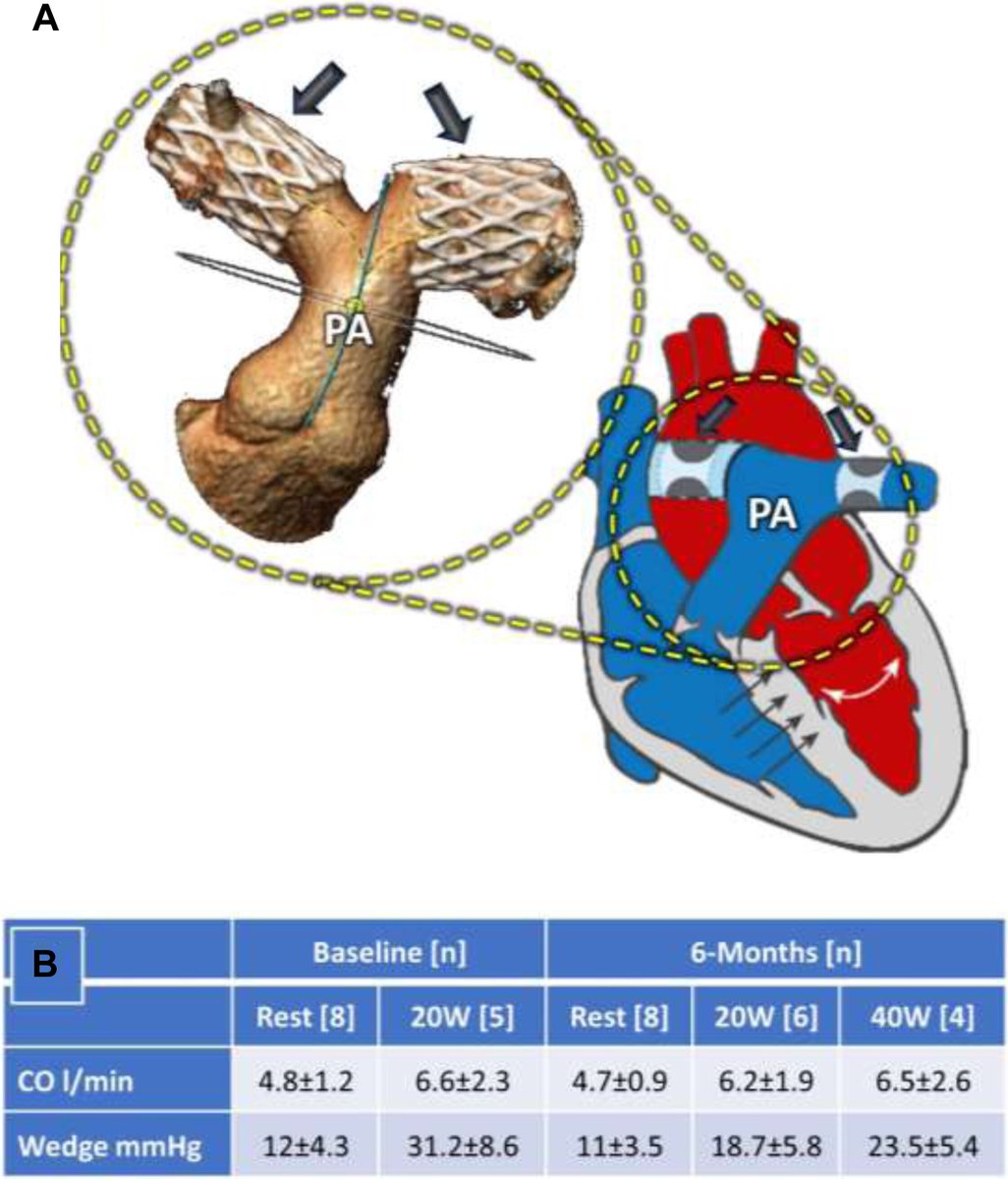 This research letter from Dr. Elchanan Bruckheimer, et al. describes initial results from a first-in-human trial of transcatheter pulmonary artery banding for #HFrEF. bit.ly/4bln0Sh #JACCBTS #HeartFailure #ACCHFT @spinneymd @VivekReddyMD