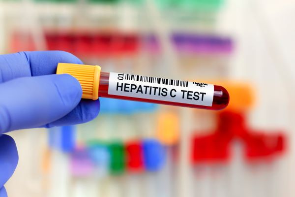 Great article by @cdchep on advancing hepatitis C diagnostics. Implementing a viral-first testing strategy, along with increasing access to treatment, will be essential to reducing #hepC in the U.S. @JIDJournal 🔗 bit.ly/3vBEZom