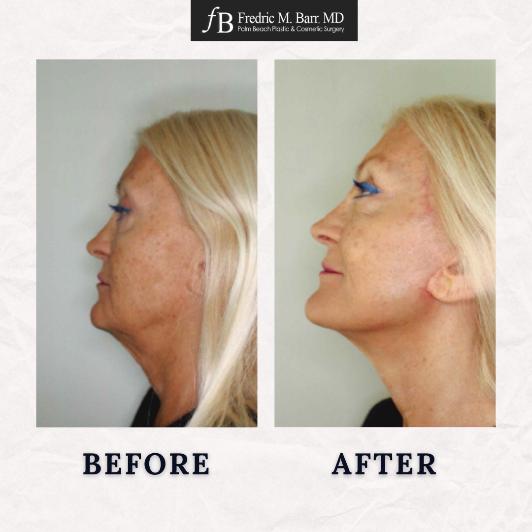 It's #TransformationTuesday!✨

Before and after photos of an Extended Neck Lift

Questions or Want to Schedule an Appointment? 
📲 Call (561) 559-7236

#beforeandafter #PalmBeach #transformation #DoctorPalmBeach #necklift #jupiter #cosmeticsurgery #plasticsurgery #plasticsurgeon