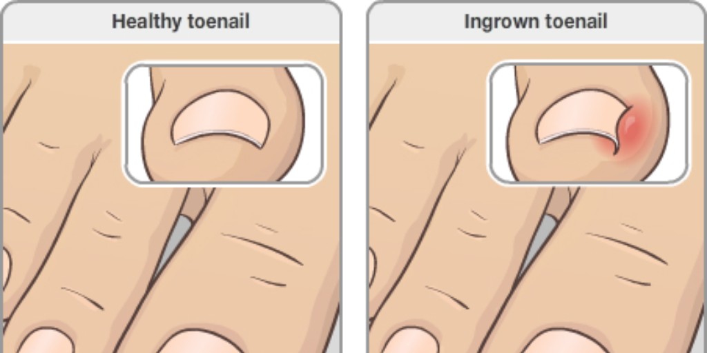 An ingrown toenail occurs when the side of the nail grows into the surrounding skin instead of straight outward. Find out how to trim nails and pick shoes to help prevent ingrown toenails: ow.ly/Esvk50RpFe6 #Dermatology #IngrownNail #HealthCare