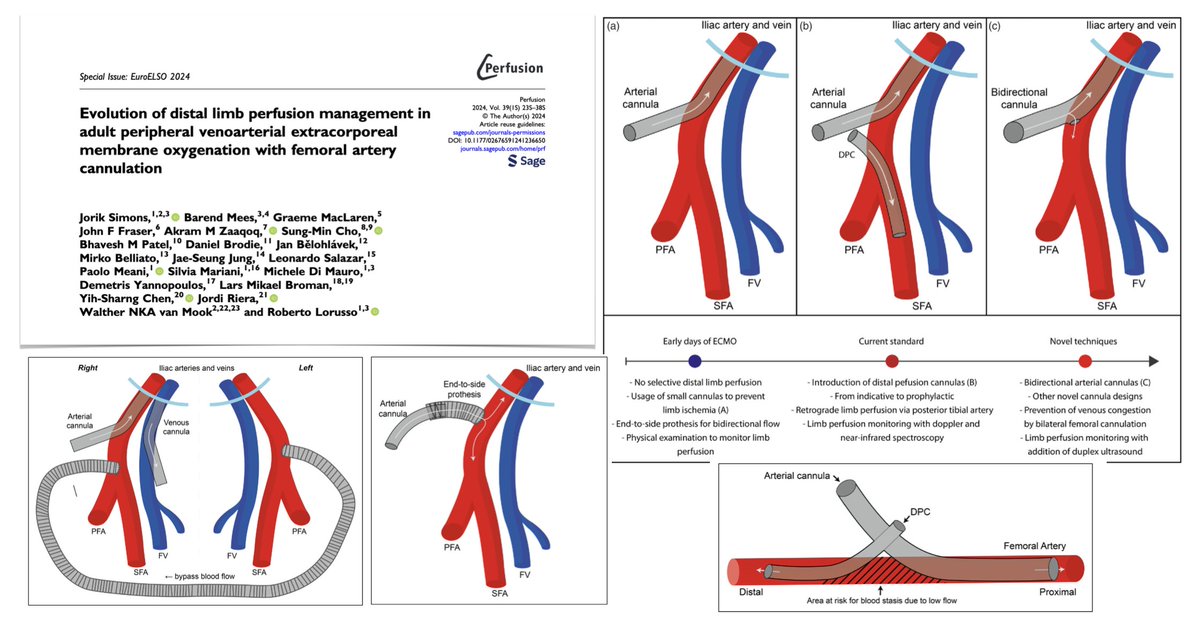 Distal limb perfusion in adults on peripheral VA #ECMO with femoral artery cannulation: 🩸 historical evolution: from early days of distal limb perfusion to advent & evolution of/evidence for DPC importance of prophylactic distal limb perfusion percutaneous vs surgical