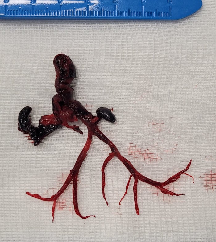 Where was this thrombotic material extracted from and with what type of procedure? What do you see in this image submitted by a team from 🇪🇸 and selected for #EuroPCR ? Cast your vote ➡️pcronline.com/Cases-resource… #interventionalcardiology #cardiotwitter