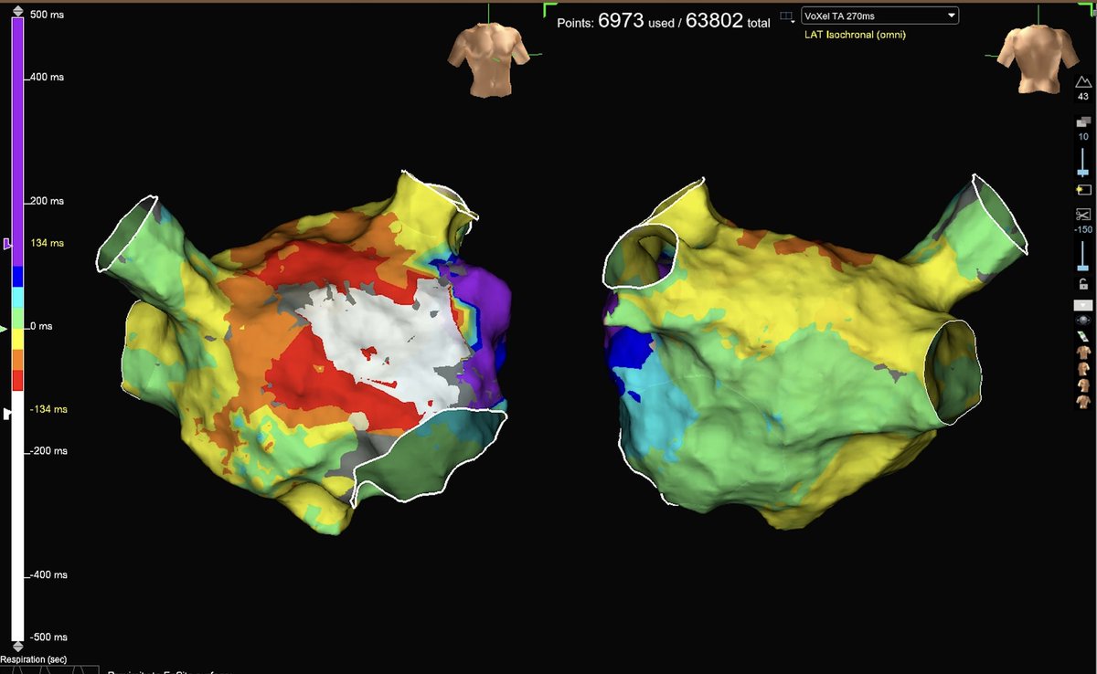 @EPeeps_Bot #epfellows patient referred for AF (?) ablation. In Lab: A flutter. No previous ablation. Where would you ablate?