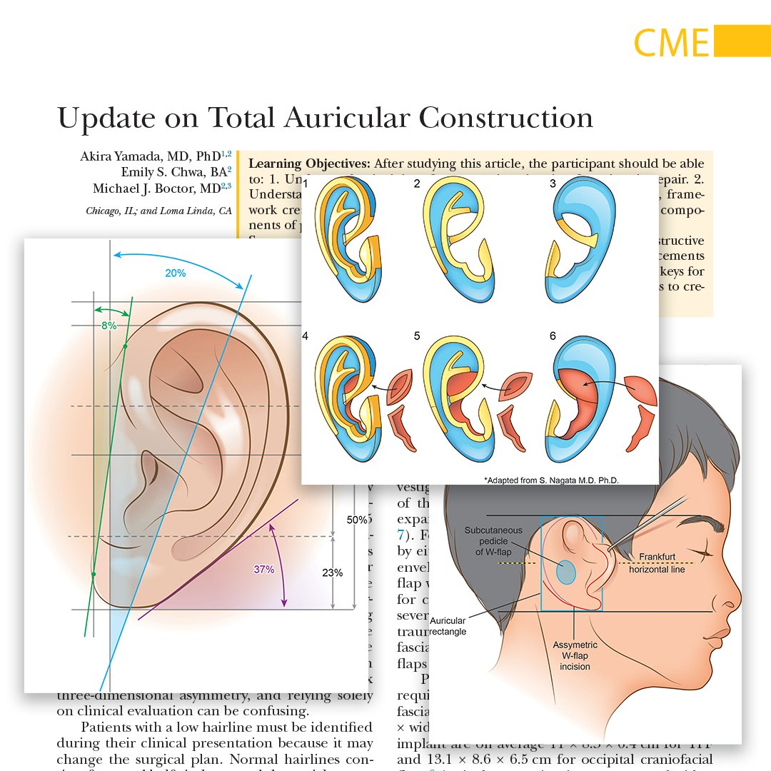 Total #AuricularConstruction remains a challenge for reconstructive surgeons. In this #PRSJournal CME article, the authors describe current surgical strategies and advancements for #microtia construction: bit.ly/TotalAuricCons…