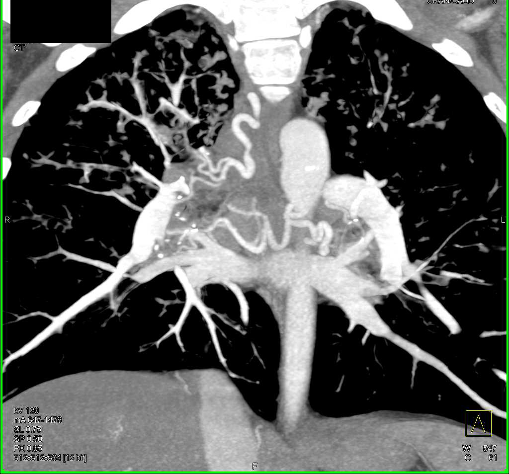 ctisus's tweet photo. Cystic Fibrosis with Dilated Bronchial Arteries: https://t.co/WYbmhJe4cr https://t.co/bjK9X66sgr