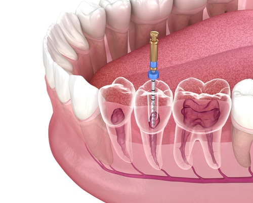 Root canal treatment, also called endodontics, is a specialized procedure to treat problems of the soft nerve tissue inside the tooth. #austin #dental #implants bit.ly/3O8agoF