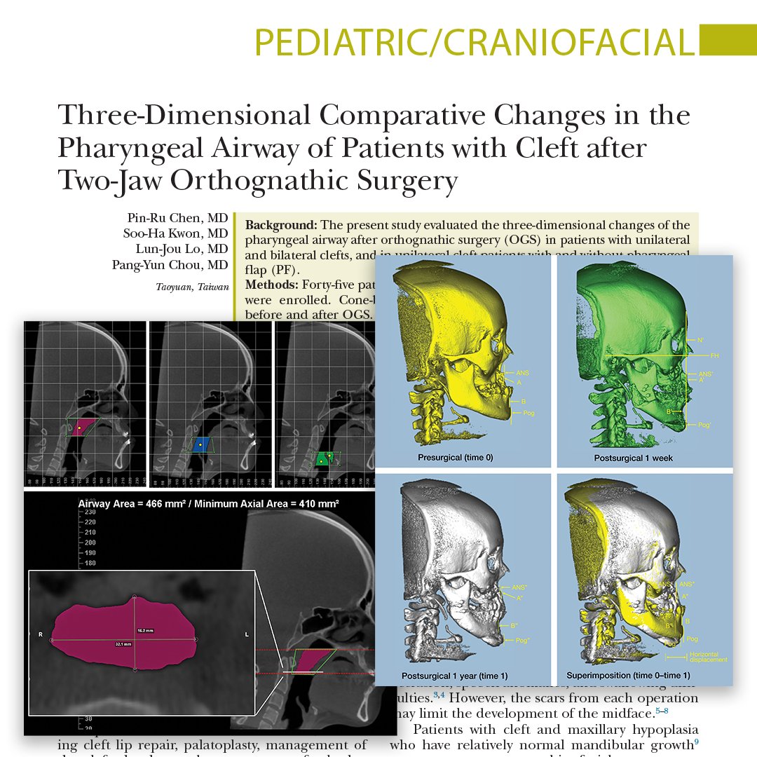This #PRSJournal study evaluated the 3D changes of the pharyngeal airway after #OrthognathicSurgery (OGS) in patients with unilateral and #bilateralclefts, and in unilateral cleft patients with and without #pharyngealflap (PF). Read the authors findings: bit.ly/3DPharyngeal