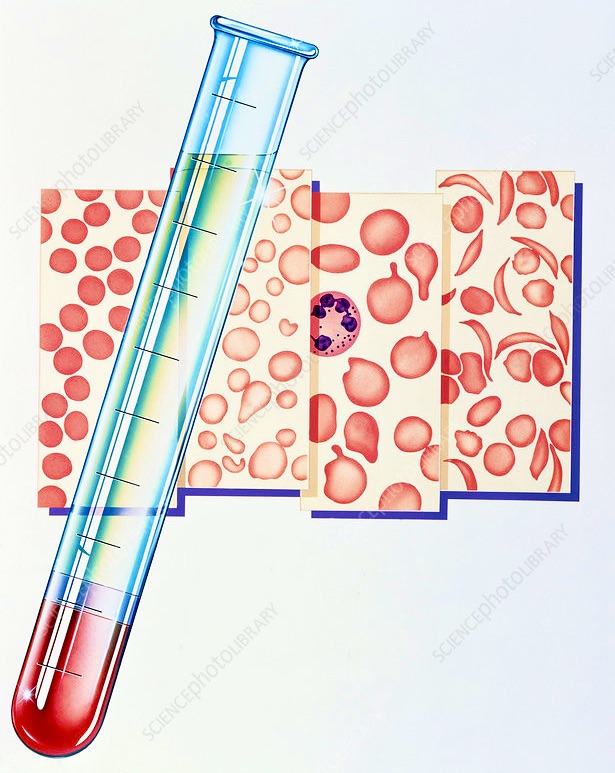 HAEMATOLOGY  /  Blood cells and types of Anaemia  /  From left:  Normal, Iron deficiency anaemia, Megaloblastic anaemia, and Sickle cell anaemia.