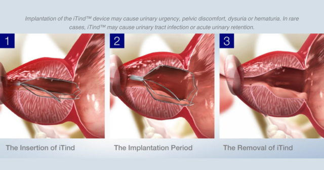 Read this #pressrelease to dive deeper into the 4+ long-term data around the iTind™ procedure for enlarged prostate treatment. #iTind #urology #MensHealth #enlargedprostate #BPH #OlympusPost bit.ly/49UHro1