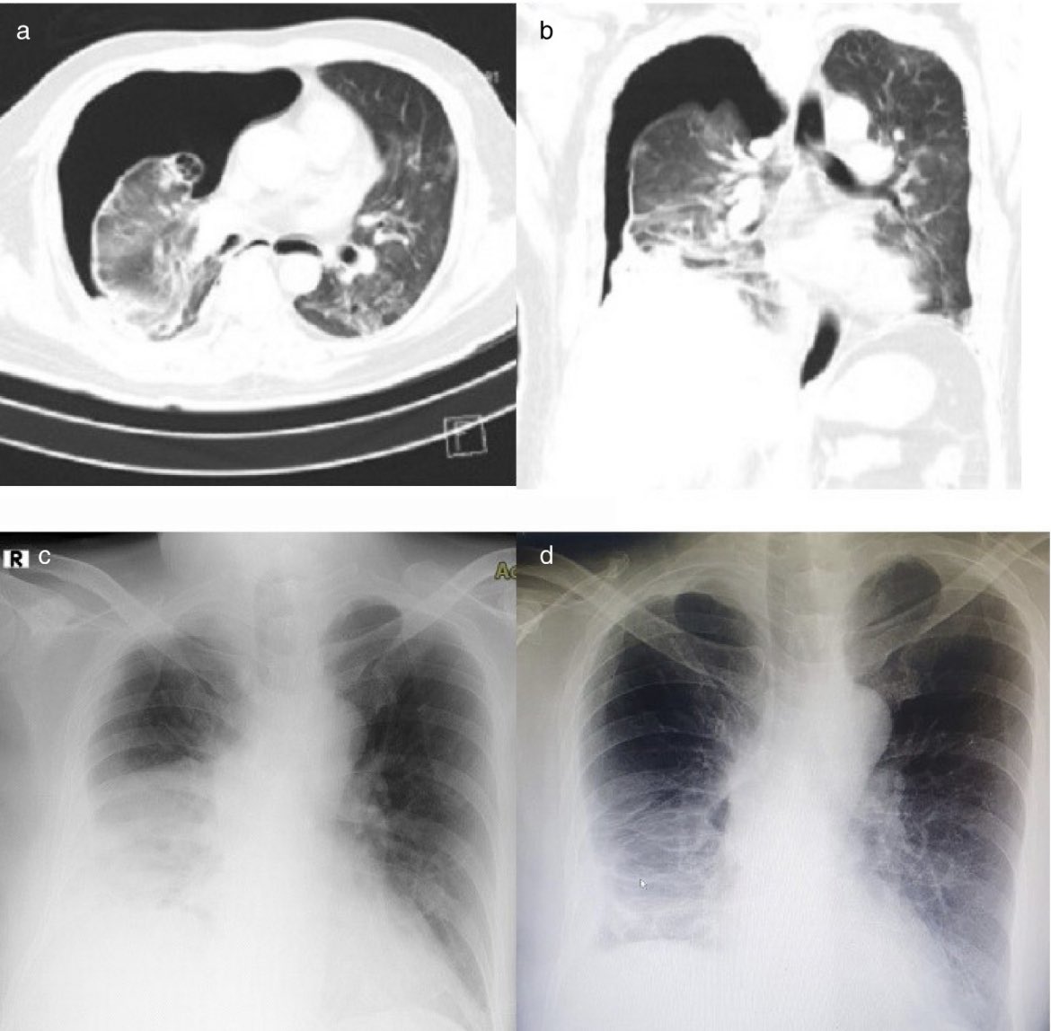 Connecting the dots:

Silent Hypoxia• Happy Hypoxia 

Shortness of breath = Walking Pneumonia.