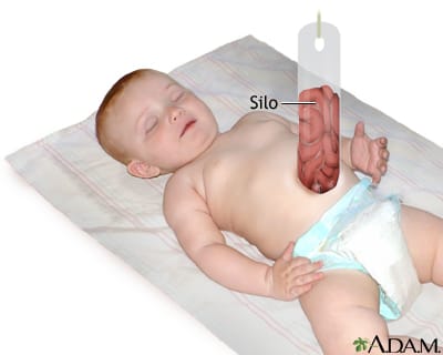 @IhabFathiSulima Gastroschisis is a birth defect in which an infant's intestines stick out (protrude) through a hole in the
abdominal wall. So a mesh sack called a silo is stitched around the borders of the defect, and the end of the silo is hung above the baby.