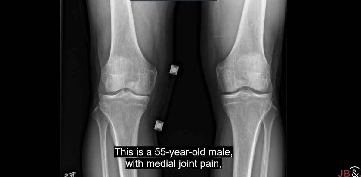 The Femur-First Technique for Oxford Medial Unicompartmental Knee Arthroplasty #knee bit.ly/44gEmNK