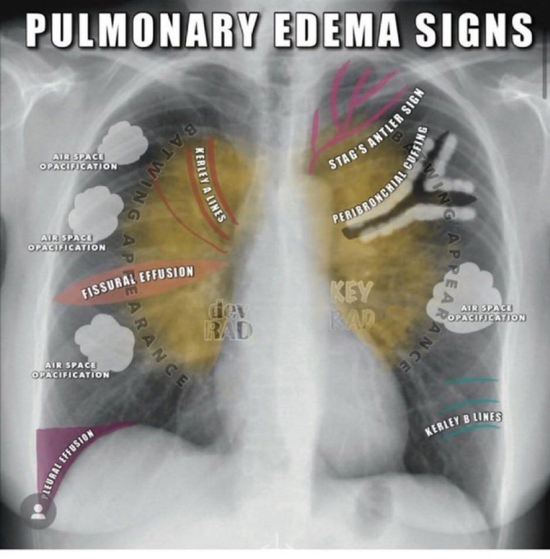 Pulmonary edema: signs & sites 🫀🫁 Cr. @drdevrad & @BrownJHM #medtwitter @Sthanu5 @IhabFathiSulima