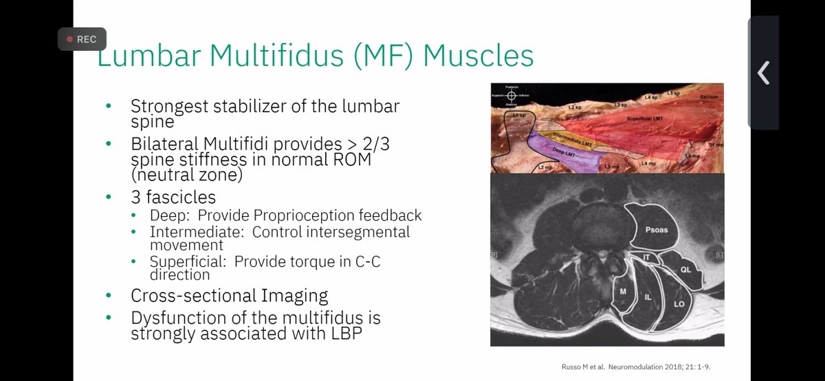 Starting out with overview of back pain @neuroradiology @WendeNGibbs @vinil_shah