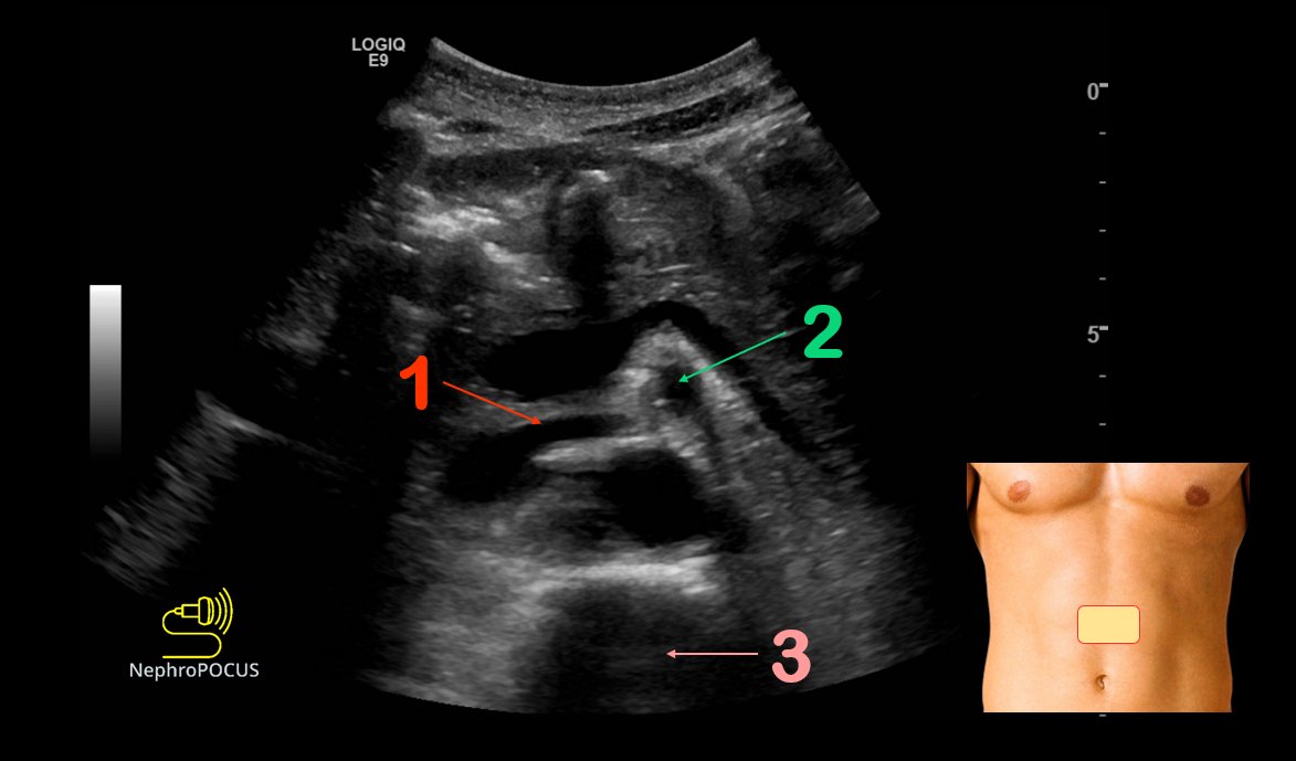 #POCUS quiz
Identify 1⃣2⃣3⃣
POLLs in thread
#Nephpearls #FOAMed #FOAMcc