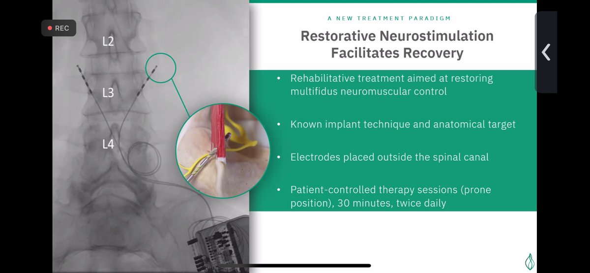 Dr. Cris Gilligan continues to discuss back pain and introduces restorative neurostimulation @WendeNGibbs @vinil_shah