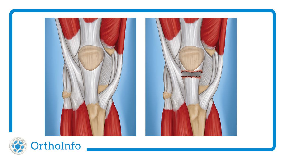 In a scary sideline collision Sunday night, @TimberWolves coach Chris Finch suffered a #patellartendontear. Learn how #patellartendontears happen and which factors raise the risk of tears at #OrthoInfo: bit.ly/3syqo7U #Orthotwitter @AOSSM_SportsMed @AANAORG @NBA