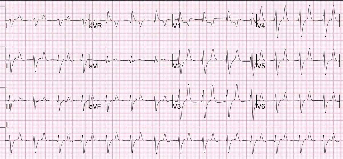 What is the rhythm? hqmeded-ecg.blogspot.com/2024/04/what-i…