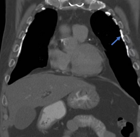 What manifestation of asbestos-related disease is highlighted by the blue arrow?

See the context for this image and more for free at amphonors.com #peermentor #anatomy #medschool #medstudent #premed