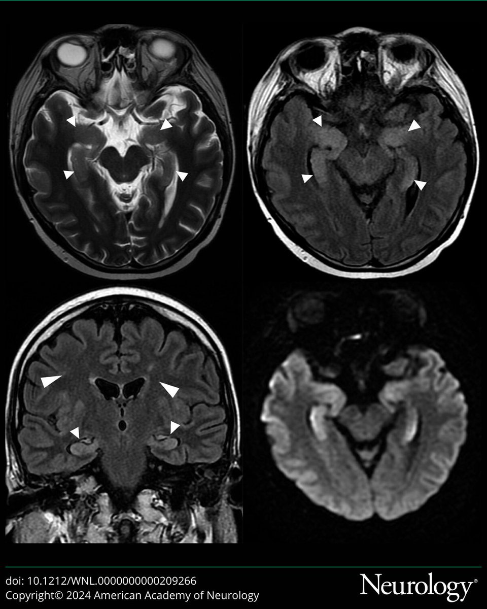 NeuroImage: Immune Effector Cell-Associated Neurotoxicity Syndrome Related to Chimeric Antigen Receptor T-Cell Therapy bit.ly/3IUJmOh

#NeuroTwitter