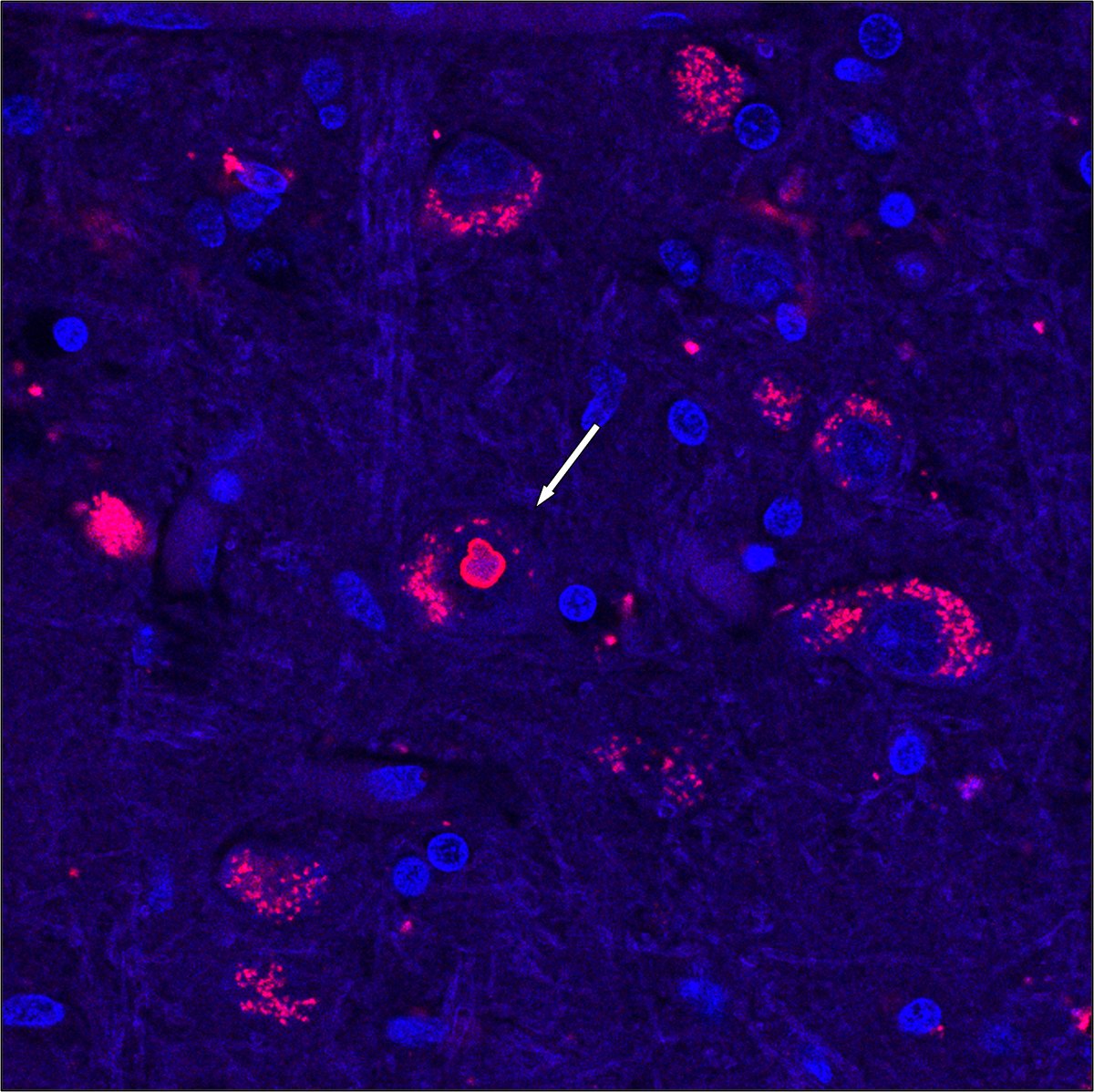 After 25 years, #UofUHealth researchers have uncovered the genetic cause behind spinocerebellar ataxia 4 (SCA4), a rare neurological disease impacting balance, sensation, and walking. @UofUNeurology @UUHSResearch 📰 bit.ly/4bjUcJY