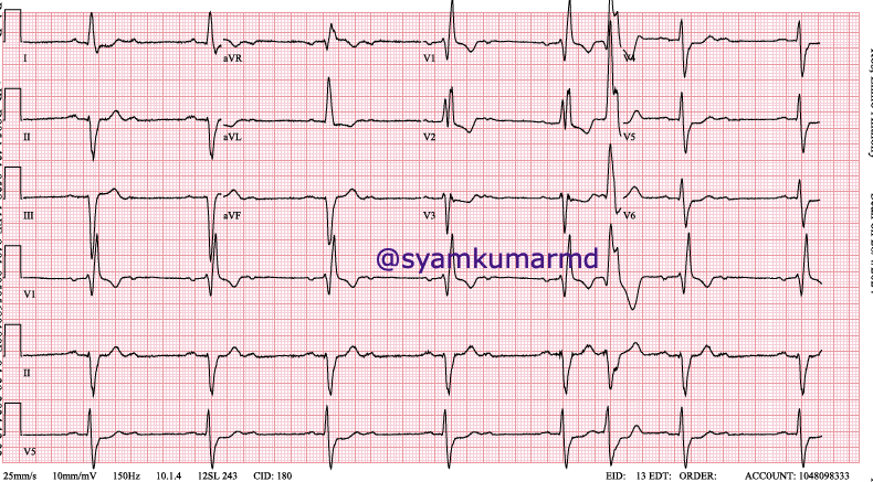 PVC making conduction better in a case of AV block referred for pacer. Plausible explanation? Hope my thoughts are not crazy!
#EPeeps