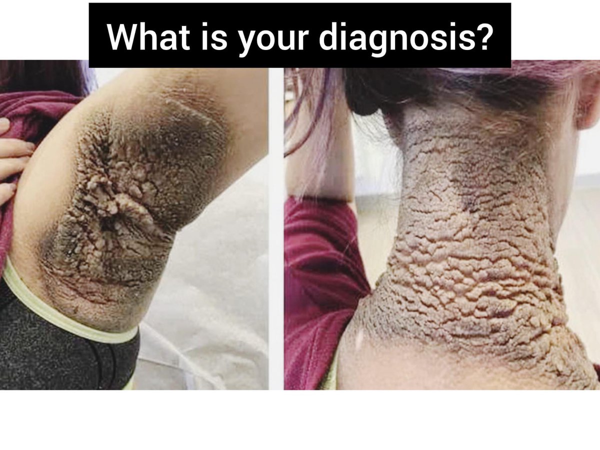 #practice

What is the diagnosis?

#MedEd 
#MEDHM 
#MedX 
@IhabFathiSulima