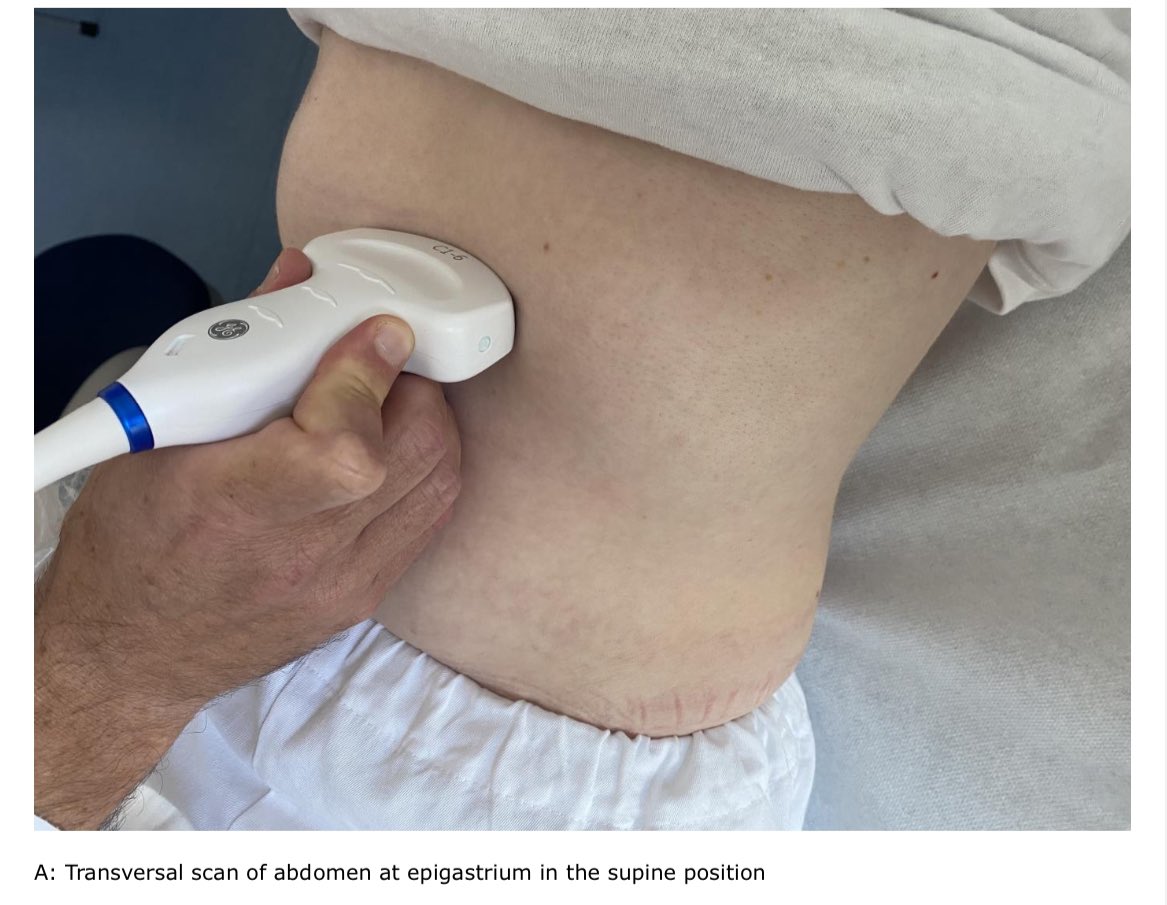 EmergPOCUS's tweet photo. 🤔 Cómo Identificar la Sonda Nasogástrica por #Ultrasonido❓❓

👇🏼👇🏼 Sigue estos pasos para aprender cómo 👇🏼👇🏼

•La NGT se visualiza como una línea #hiperecoica, ya sea simple o doble.

•#Procedimiento de Búsqueda 📍

•🕵️‍♀️ Primero se busca la sonda en el #antro del estómago.

•Luego se procede a verificar en el #fondo del estómago. 👇🏼

CHEST 2021; 159(6):2366-2372