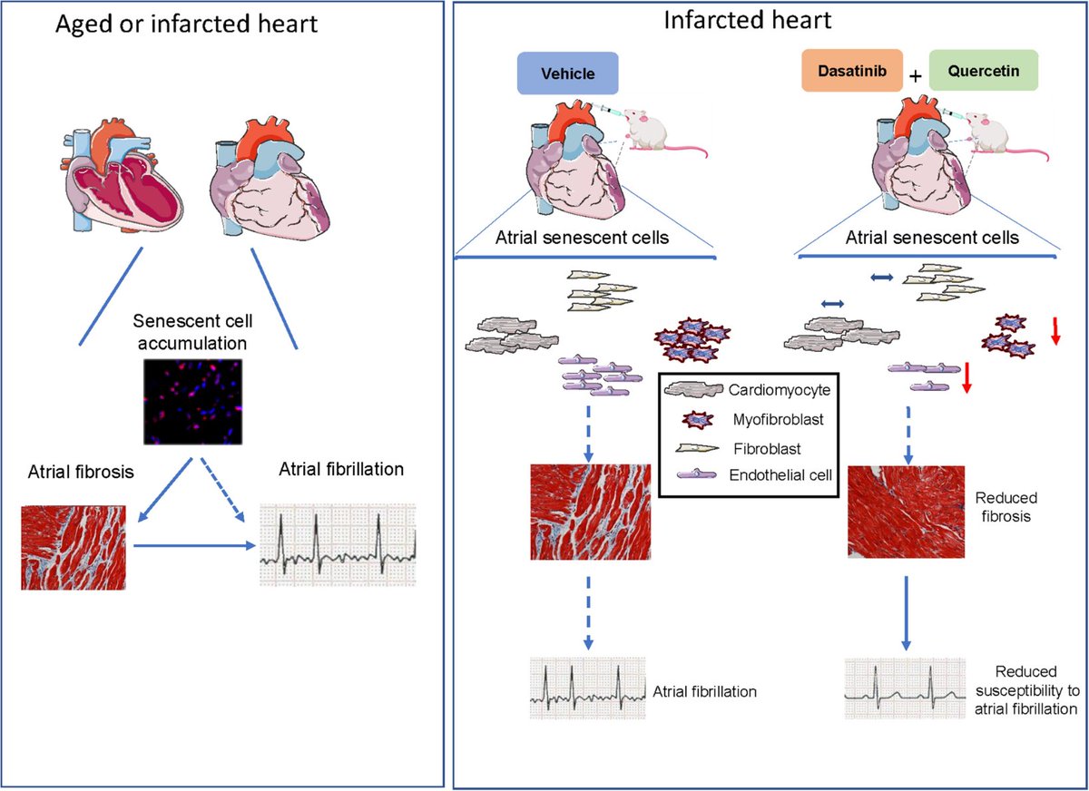 The role of cellular senescence in profibrillatory atrial remodelling associated with cardiac pathology

🔎'Senolytic therapy reduced AF inducibility in MI rats... and attenuated LA fibrosis...'

@MozhdehMehdiza1 @StanleyNattel 

academic.oup.com/cardiovascres/…